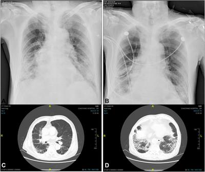 Elevated INR in a COVID-19 patient after concomitant administration of azvudine and anticoagulants